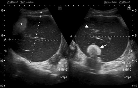 Dermoid Ovarian Cyst Ultrasound