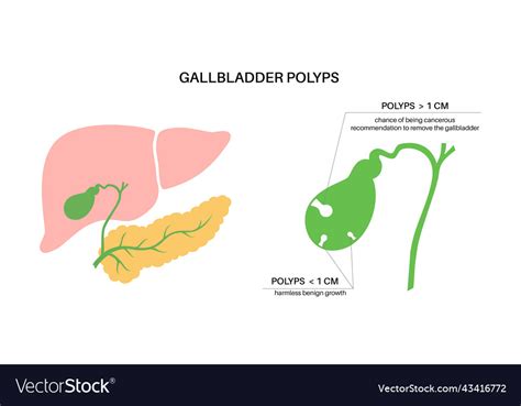 Gallbladder Polyp, Causes, Signs And Symptoms, Diagnosis, 44% OFF