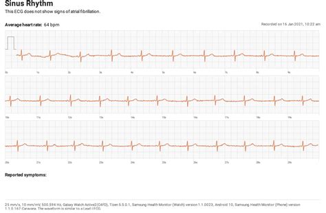 ECG graph from Samsung galaxy active 2 is less cleaner than apple watch ...