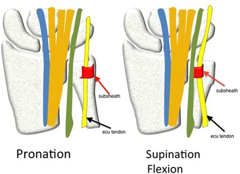 Sports-related extensor carpi ulnaris pathology: a review of functional anatomy, sports injury ...