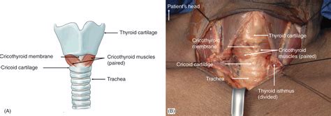 Tracheostomy Vs Cricothyrotomy