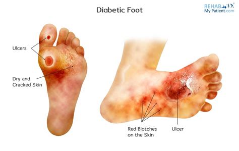 Diabetic (Charcot) Foot | Rehab My Patient