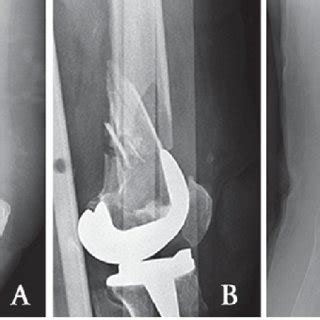 a, b) AP and Lateral x-rays showing a periprosthetic distal femur ...