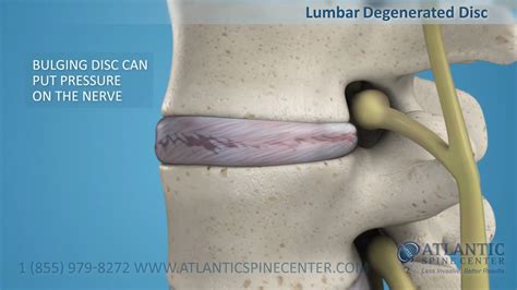 Lumbar Degenerative Disc Disease - YouTube