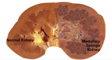 MEDULLARY SPONGE KIDNEY - New