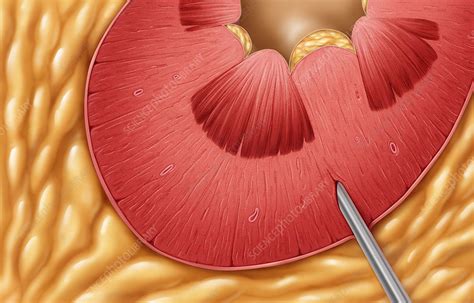 Renal Biopsy - Stock Image - M490/0060 - Science Photo Library