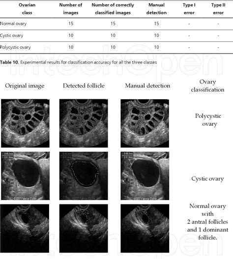 Normal Ovary Ultrasound Vs Pcos Ultrasound