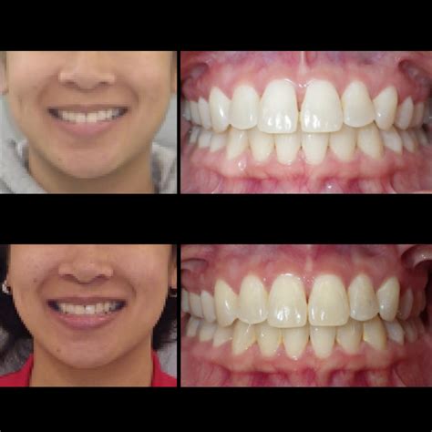 Before & After Photo Gallery | SureSmile UK