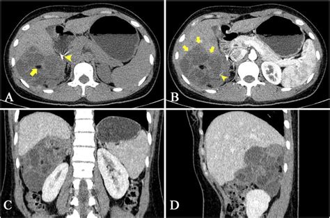 -CT scan through the abdominal shows a mature cystic teratoma in the... | Download Scientific ...