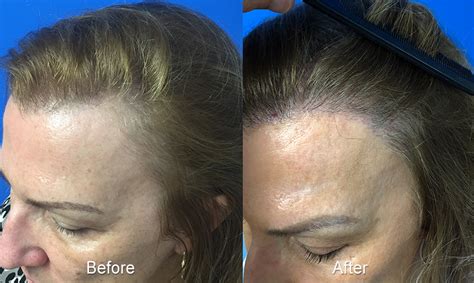 Female Hairline Restoration Case Study - Hair Restoration Center of CT ...