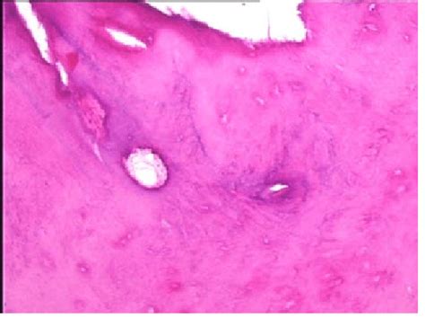 Histopathologic examination showed dens, irregularly lamellated,... | Download Scientific Diagram