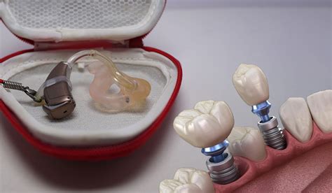 Endosteal Implant vs Subperiosteal Implant: Which is Better?