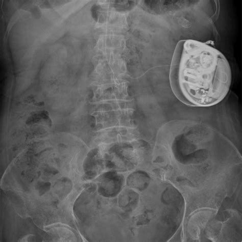 Intrathecal morphine pump implanted subcutaneously with tube insertion ...