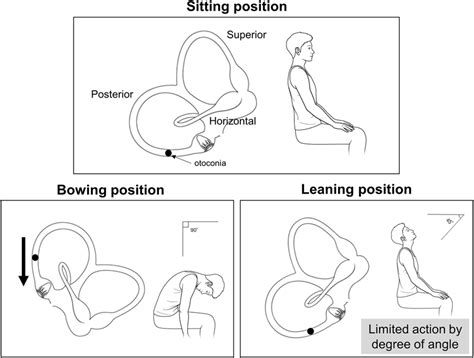 Possible mechanisms for certain directions of vertical nystagmus in the... | Download Scientific ...