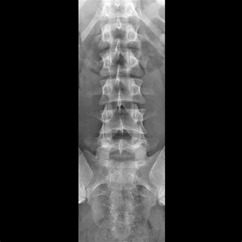 Lumbar Spine: Lumbar Spine Radiology