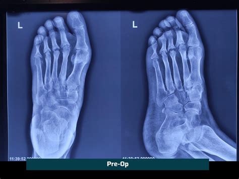 Deformity Corrections | Knee & Foot | Dr. Rachit Sheth