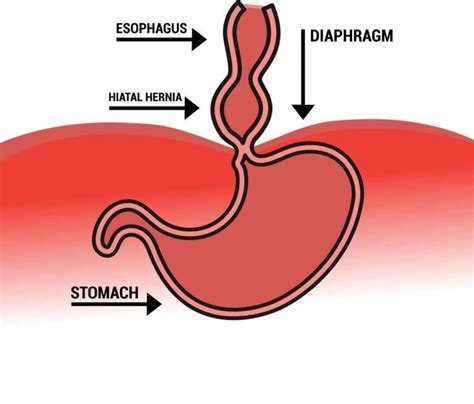 Hiatal Hernia: Is it Related to Back Pain?