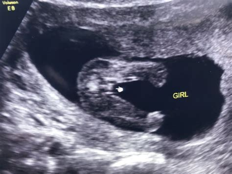 15/16 week ultrasound boy or girl?! | BabyCenter