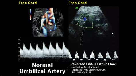 Umbilical Artery Doppler Ultrasound Normal Vs Abnormal Image Appearances | Spectral Doppler USG ...