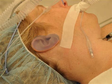 Ear reconstruction surgery (Graphic Photos) - Photo 9 - Pictures - CBS News