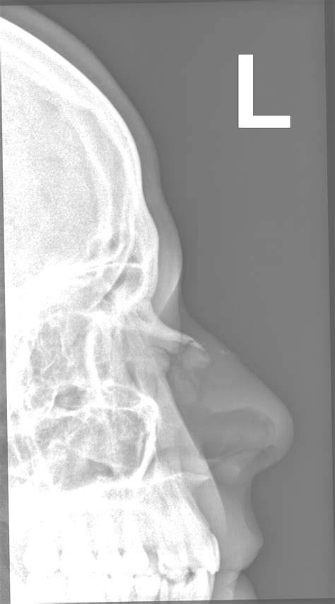 Nasal bone fracture | Image | Radiopaedia.org