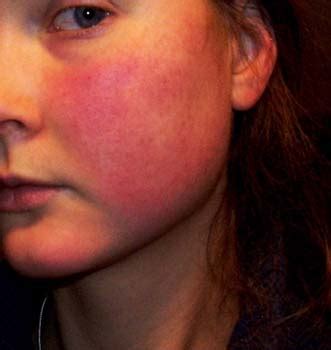 Acne Rosacea Symptoms - WelcomeCure