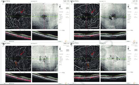 OCT-angiography of both eyes at the superficial (a and c) and deep ...