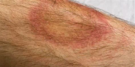 Tick Bite – Pictures, Symptoms, Causes, Treatment | hubpages
