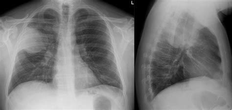 Round Pneumonia in a 50-Year-Old Man | Respiratory Care