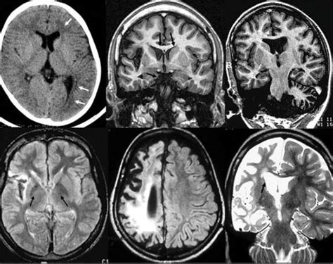 ABC Radiology Blog: Rasmussen's Encephalitis MRI Findings