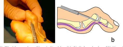 Figure 1 from Percutaneous correction of second toe proximal deformity ...