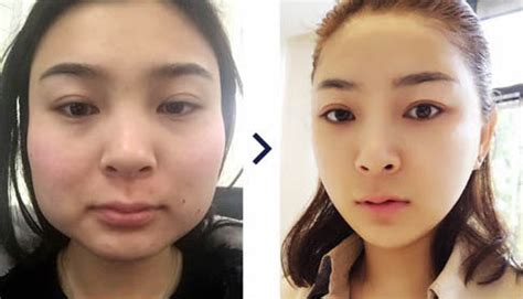 Non-invasive Techniques for a V-line Face Shape - MedisetterMedisetter