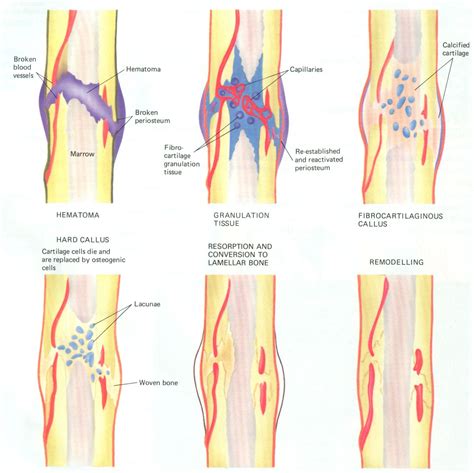 Healing of a bone fracture | Medical knowledge, Nurse teaching, Nursing ...