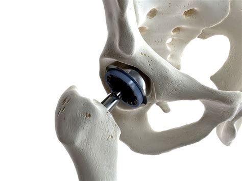 Biomet Hip Replacement Lawyer | Saunders & Walker PA