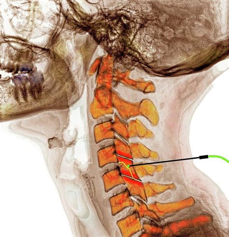 Spinal Facet Joint Nerve Ablation Photograph by Medical Media Images / Science Photo Library