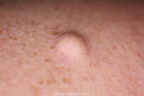 Sebaceous Cyst - South East Skin Clinic