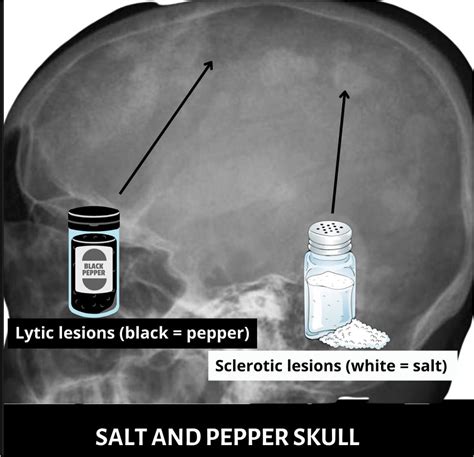 Salt And Pepper Skull - My Endo Consult