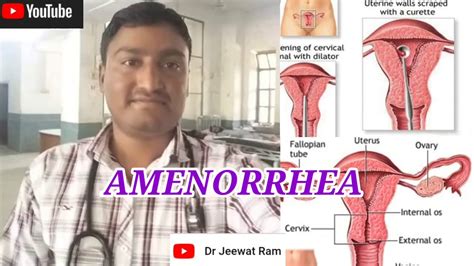 Amenorrhea, introduction, types,causes,signs,symptoms diagnosis and treatment - YouTube