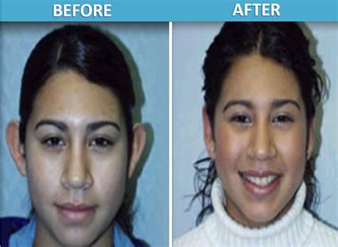 Otoplasty Before & After Photos - Center for Cosmetic Surgery in San Diego