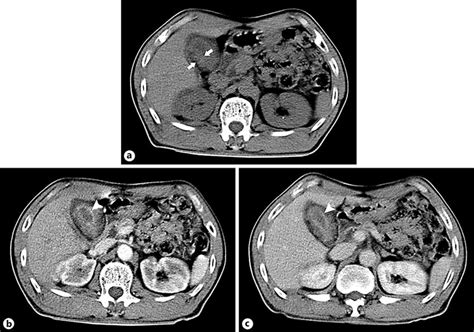 Figure 2 from Diffuse Gallbladder Adenomyomatosis with an Inflammatory ...