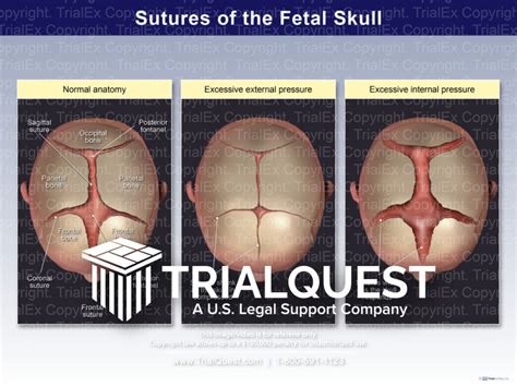 Sutures of the Fetal Skull - TrialExhibits Inc.