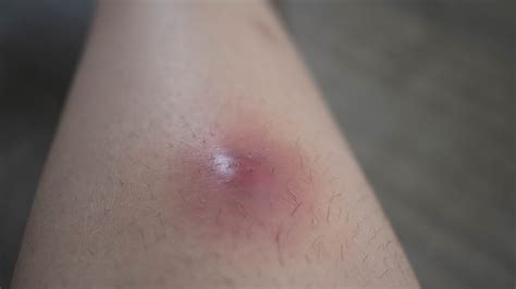 Ingrown Hair Staph Infection