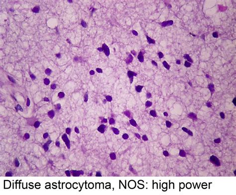 Pathology Outlines - Diffuse astrocytoma IDH mutant