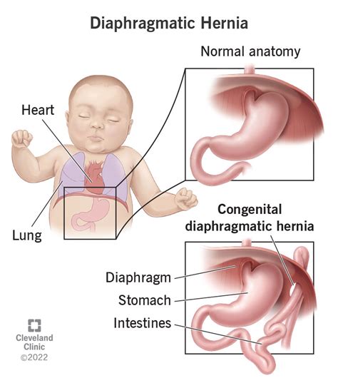 Congenital Diaphragmatic Hernia: Symptoms, Types & What It Is