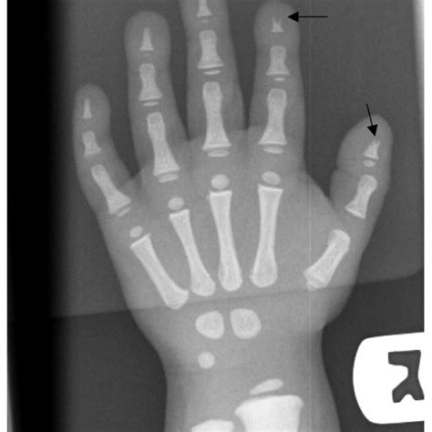 (PDF) Osteopetrosis