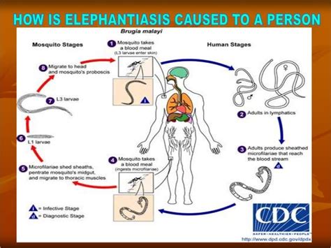 Elephantiasis presentation1