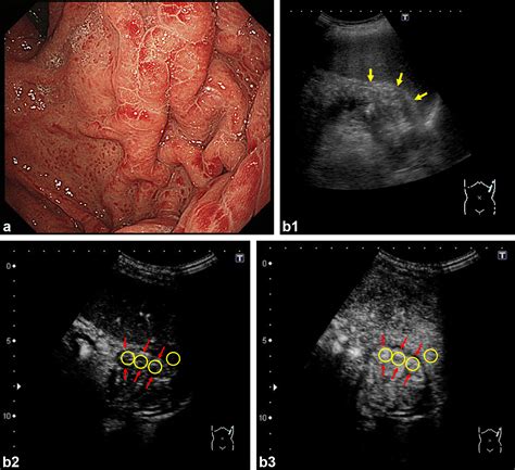 Non-Invasive Diagnosis of Portal Hypertensive Gastropathy: Quantitative ...