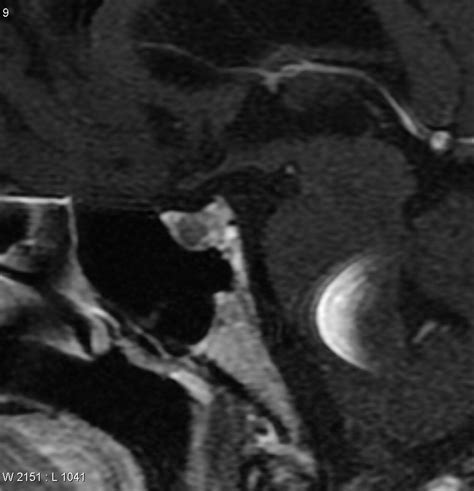 Pituitary Adenoma On Mri