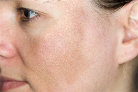 Sun-Damaged Skin: Causes And Effect - Arsenault Dermatology