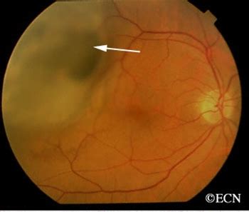 Choroidal Melanoma » New York Eye Cancer Center